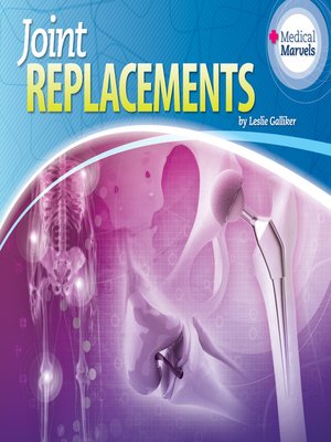 cover image of Joint Replacements